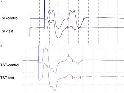 Corticospinal Tract Impairment of Patients With Parkinson’s Disease: Triple Stimulation Technique Findings